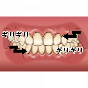 歯ぎしり、食いしばりの及ぼす影響