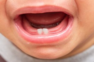 永久歯がなかなか生えてこない…萌出遅延の原因と対処法