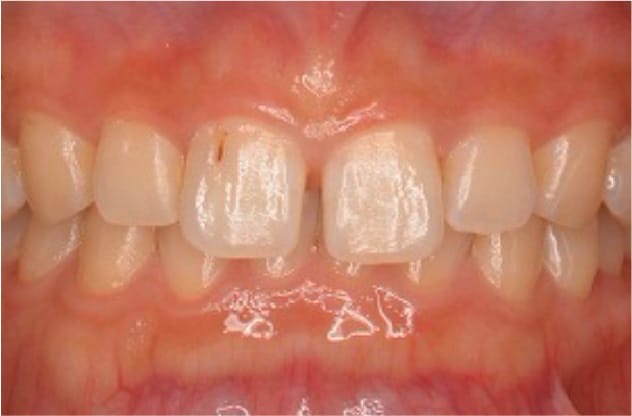 すきっ歯治療について