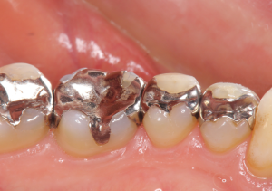 金銀パラジウム合金