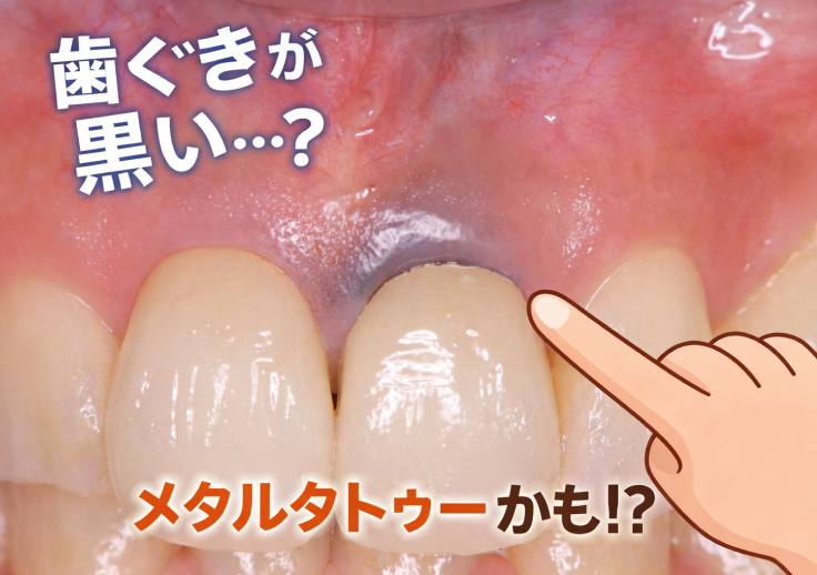 歯ぐきが黒い原因は？「メタルタトゥー」の正体と治療法をわかりやすく解説