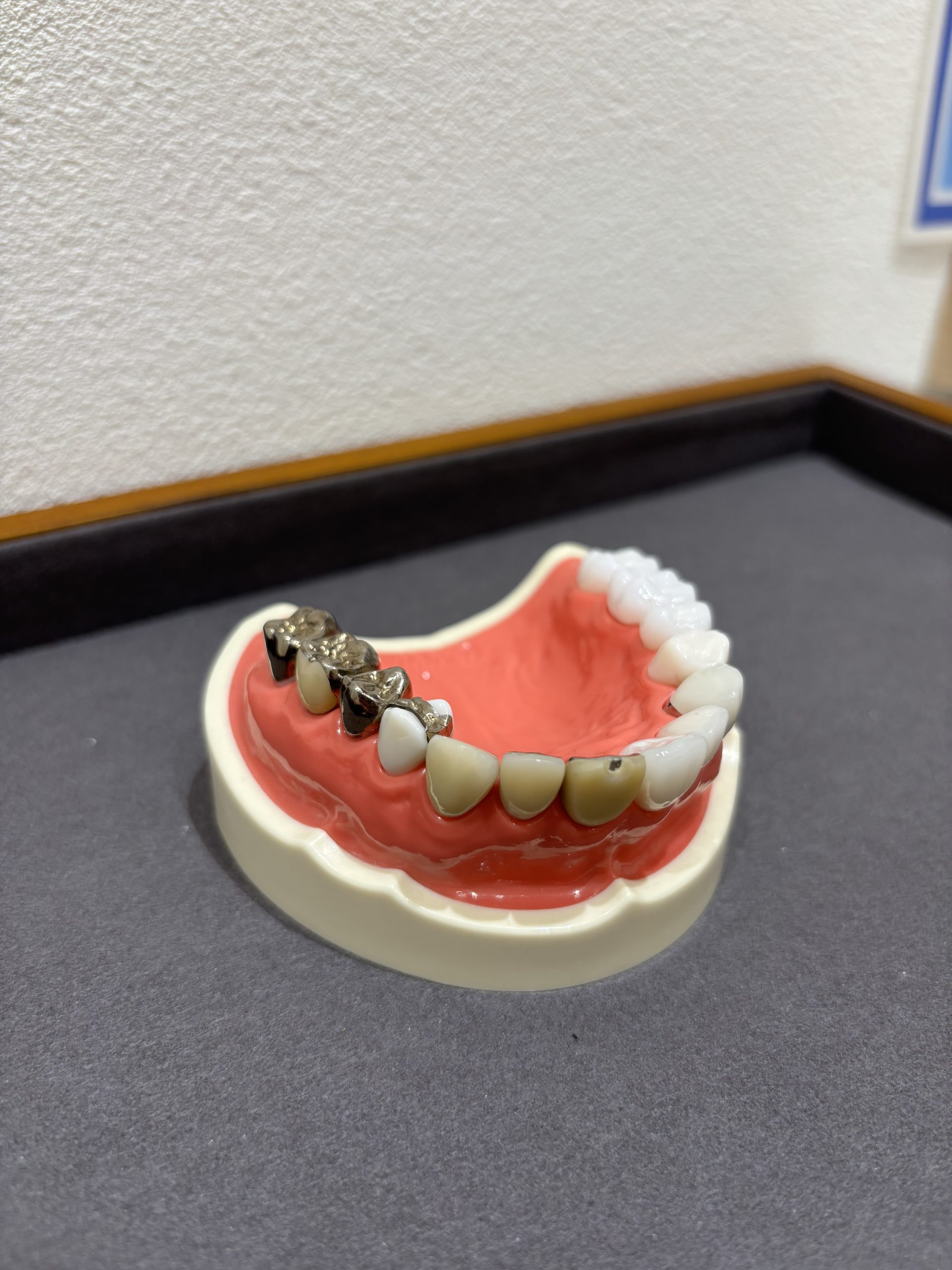 銀歯の虫歯再発リスク